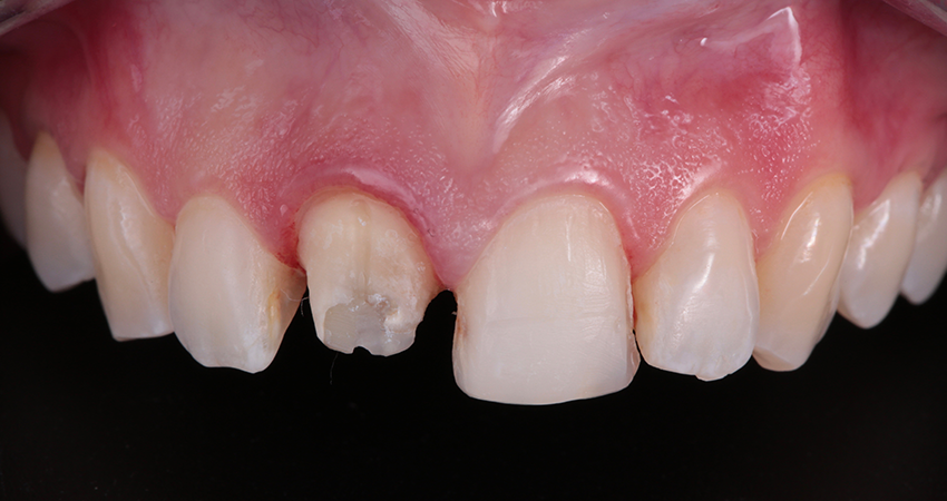 Gereinigte Veneer- und Kronenpräparationen an den Zähnen 11 und 12 bereit für die Einprobe. Bilder mit freundlicher Genehmigung von Dr. Paulo Monteiro.